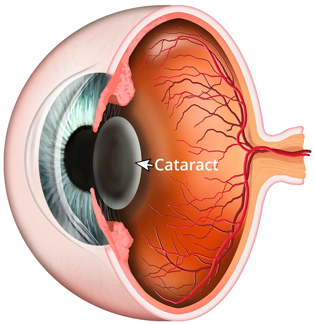 Cross-sectional diagram of a human eye affected by a cataract, showing a cloudy lens that impairs vision.